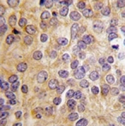 IHC analysis of FFPE human prostate carcinoma tissue stained with PRMT3 antibody