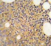 IHC analysis of FFPE human prostate carcinoma tissue stained with PRMT3 antibody