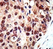 IHC analysis of FFPE human breast carcinoma tissue stained with the PRMT3 antibody