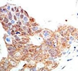 IHC analysis of FFPE human breast carcinoma tissue stained with the PRMT5 antibody~