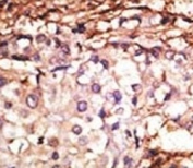 IHC analysis of FFPE human breast carcinoma tissue stained with the PRMT6 antibody
