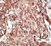 IHC analysis of FFPE human hepatocarcinoma stained with the PRMT7 antibody