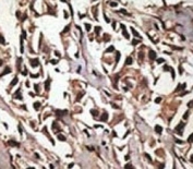 IHC analysis of FFPE human breast carcinoma tissue stained with the PRMT7 antibody