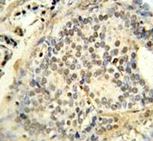 FUS antibody immunohistochemistry analysis in formalin fixed and paraffin embedded human prostate carcinoma.