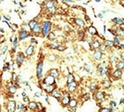 IHC analysis of FFPE human hepatocarcinoma stained with the Dnmt2 antibody