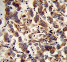 TFAM antibody immunohistochemistry analysis in formalin fixed and paraffin embedded human testis carcinoma.