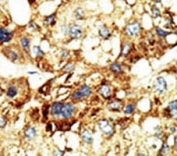 IHC analysis of FFPE human hepatocarcinoma stained with the Dnmt3a antibody