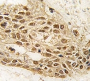 IHC analysis Dnmt3a antibody and human lung carcinoma tissue