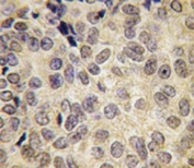 IHC analysis of FFPE human prostate carcinoma tissue stained with Dnmt3b antibody