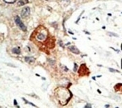 IHC analysis of FFPE human breast carcinoma tissue stained with the UBE2I antibody
