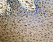 SREBP2 antibody immunohistochemistry analysis in formalin fixed and paraffin embedded human skin carcinoma.