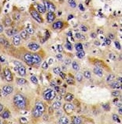 IHC analysis of FFPE human hepatocarcinoma stained with HDAC6 antibody