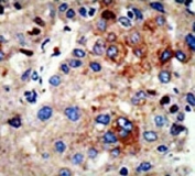 IHC analysis of FFPE human hepatocarcinoma stained with HDAC9 antibody