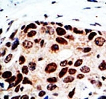 IHC analysis of FFPE human breast cancer tissue stained with the HDAC9 antibody