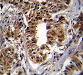 CAD antibody immunohistochemistry analysis in formalin fixed and paraffin embedded human breast carcinoma.