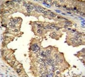 IHC testing of PRMT4 antibody and FFPE human prostate carcinoma.