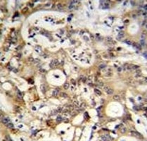 SP1 antibody immunohistochemistry analysis in formalin fixed and paraffin embedded human colon carcinoma.