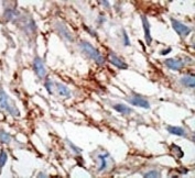 IHC analysis of FFPE human breast carcinoma tissue stained with the ISG15 antibody