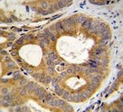 TRPM8 antibody immunohistochemistry analysis in formalin fixed and paraffin embedded human prostate carcinoma.~