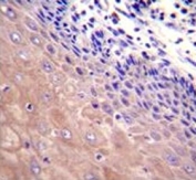 GCLC antibody immunohistochemistry analysis in formalin fixed and paraffin embedded human esophageal carcinoma.