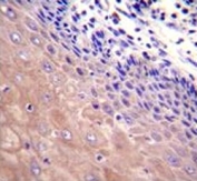 GCLC antibody immunohistochemistry analysis in formalin fixed and paraffin embedded human esophageal carcinoma.