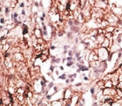 IHC analysis of FFPE human breast carcinoma tissue stained with the LSD1 antibody