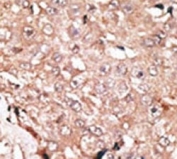 IHC analysis of FFPE human hepatocarcinoma stained with the LSD1 antibody