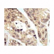 IHC analysis of FFPE human breast carcinoma tissue stained with the SUMO1 antibodyFITC-conjugated goat-anti-rabbit secondary Ab was used for the analysis.