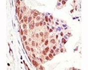 IHC analysis of FFPE human breast carcinoma tissue stained with the SUMO antibody