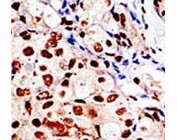IHC analysis of FFPE human breast carcinoma tissue stained with the SUMO antibody