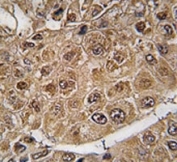 IHC analysis of FFPE human hepatocarcinoma tissue stained with SUMO2/3 antibody