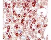 IHC testing of human hepatocarcinoma stained with SUMO2/3 antibody.