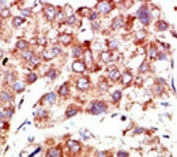 IHC analysis of FFPE human hepatocarcinoma stained with the NEDD8 antibody