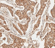 IHC staining of FFPE human breast carcinoma with anti-Ubiquitin antibody. HIER: boil tissue sections in pH 9 10mM Tris with 1mM EDTA for 20 min and allow to cool before testing.