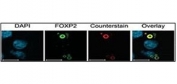 Characterization of FOXP2 isoforms using FOXP2 Ab (green) and Ubiquitin antibody (aggresome marker) (red). Nuclei are marked by DAPI staining (blue). Ubiquitin co-localizes with FOXP2.10t aggregates suggesting that these cellular bodies represent aggresomes.