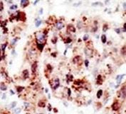 IHC analysis of FFPE human hepatocarcinoma stained with the Ubiquitin antibody