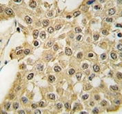 IHC analysis of FFPE human breast carcinoma tissue stained with the MDM2 antibody