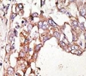 IHC analysis of FFPE human hepatocarcinoma stained with the SUMO4 antibody