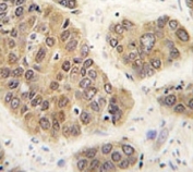IHC analysis of FFPE human hepatocarcinoma tissue stained with SUMO4 antibody