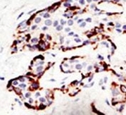 IHC analysis of FFPE human breast carcinoma tissue stained with the SUV39H2 antibody.