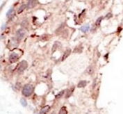 IHC analysis of FFPE human breast carcinoma tissue stained with the SUV39H2 antibody.