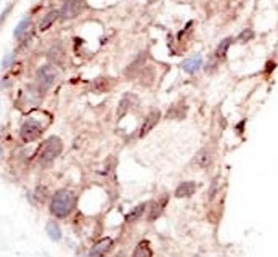 IHC analysis of FFPE human breast carcinoma tissue stained with the SUV39H2 antibody
