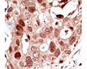 IHC analysis of FFPE human breast carcinoma tissue stained with the SUMO2 antibody