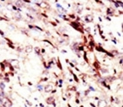 IHC analysis of FFPE human hepatocarcinoma tissue stained with the SUMO2/3 antibody