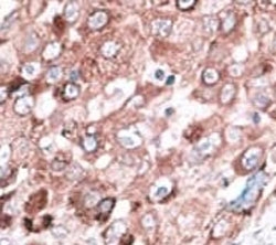 IHC analysis of FFPE hepatocarcinoma cancer tissue stained with the Bak antibody~