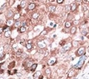 IHC analysis of FFPE hepatocarcinoma cancer tissue stained with the Bak antibody
