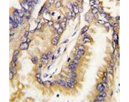 IHC analysis of FFPE human lung carcinoma tissue stained with Bid antibody