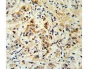 Bid antibody IHC analysis in formalin fixed and paraffin embedded human breast carcinoma.