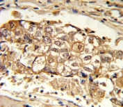 IHC analysis of FFPE human breast carcinoma with MCL1 antibody