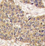 IHC analysis of FFPE human hepatocarcinoma tissue stained with Caspase-6 antibody